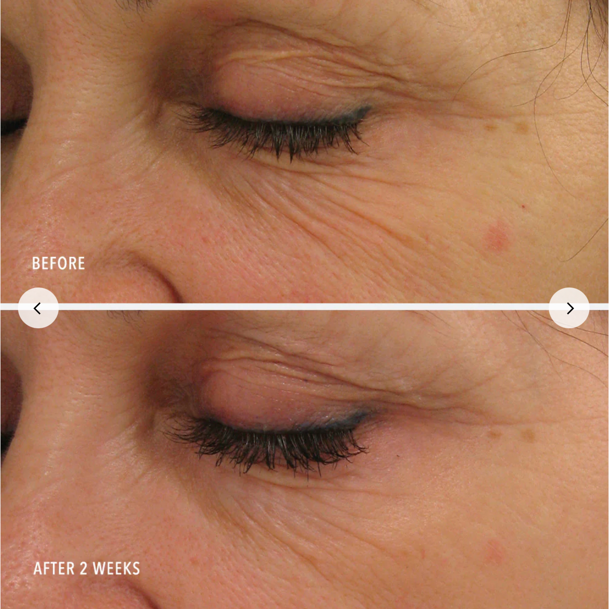 Before and after comparison of a person's eye area with visible skin texture changes over two weeks.