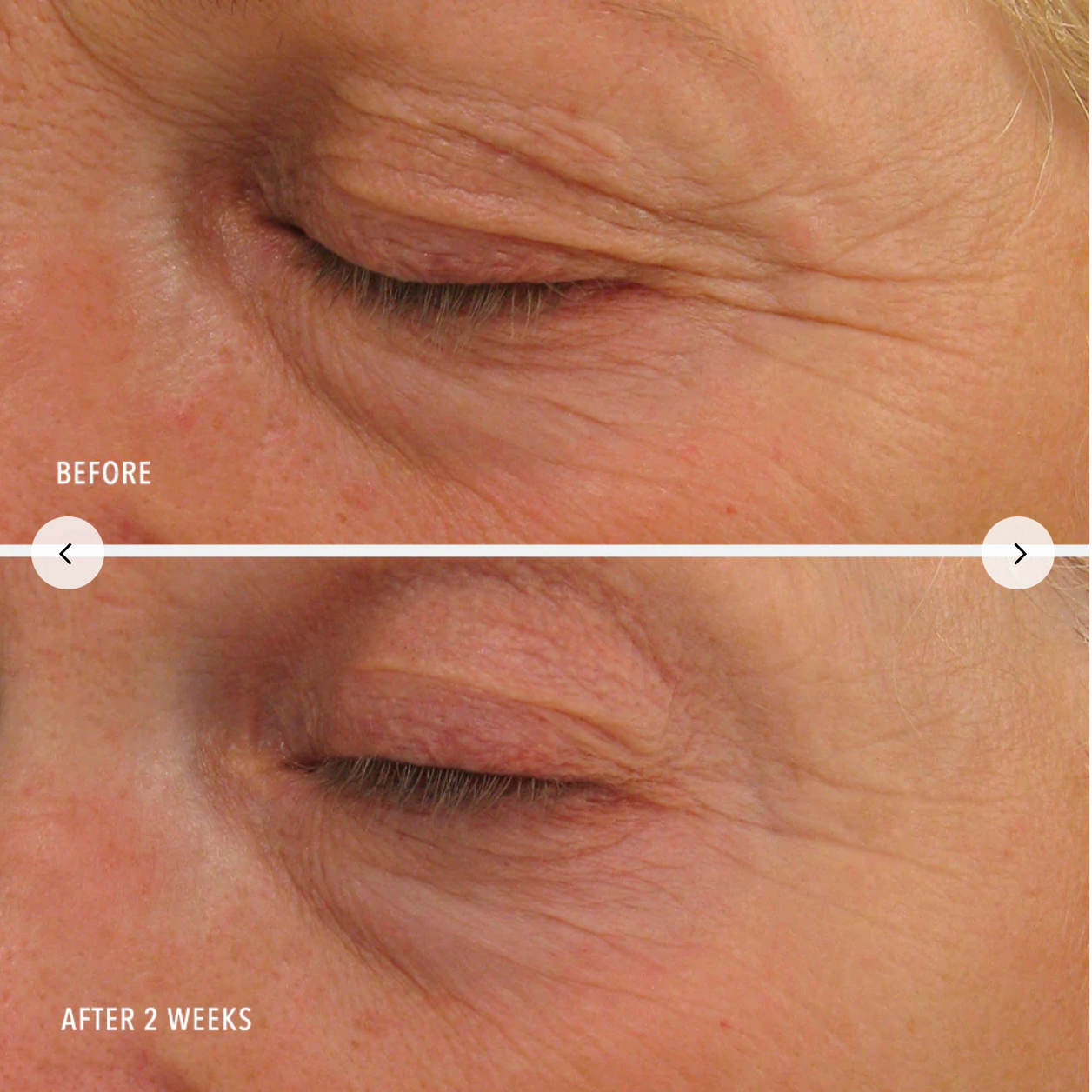 Before and after comparison of eye area skin texture on a person's face.
