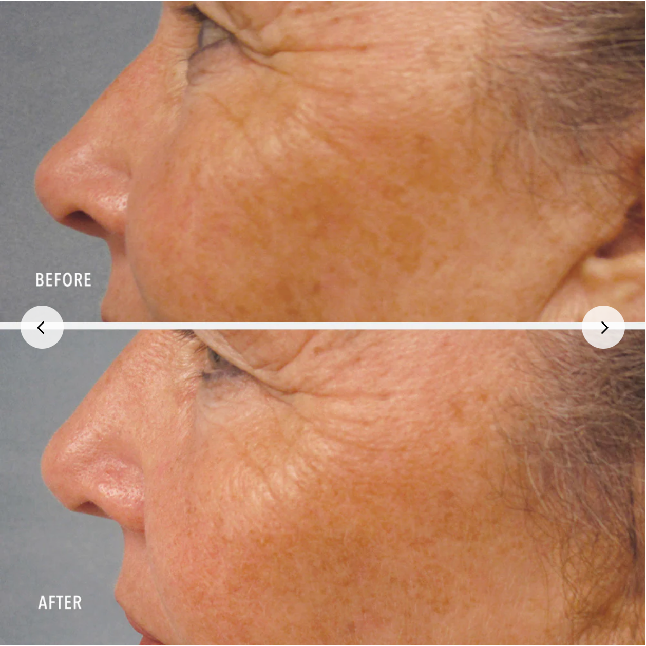 Before and after comparison of facial skin texture on a gray background