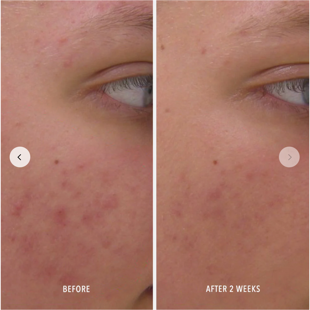 Acne Breakouts & Pimples