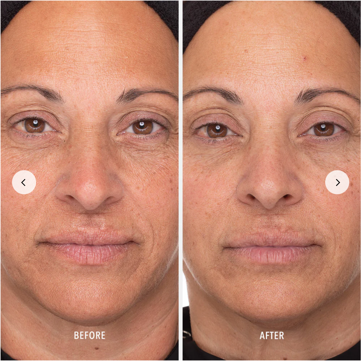 Pigmentation